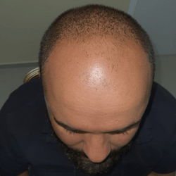 Antes-do-Transplante-Capilar-Paciente-1