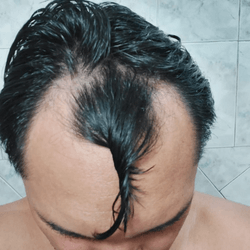 Antes-do-transplante-FUE-paciente-2