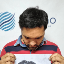 Depois-do-transplante-FUE-paciente-2